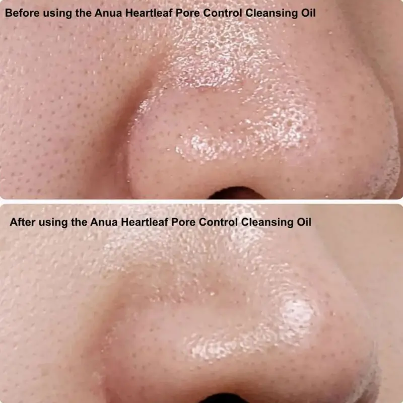 قبل و بعد استفاده روغن آنوا