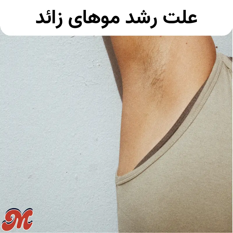 علت رشد موهای زائد چیست؟